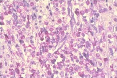 Systemic mastocytosis. Bone marrow biopsy, toluidi