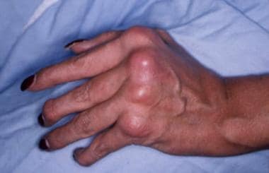 Swelling and deformity of the metacarpophalangeal 