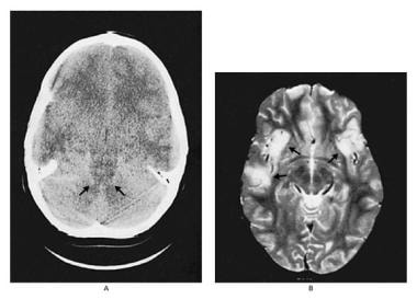 Left image of a CT scan of an 8-year-old boy with 