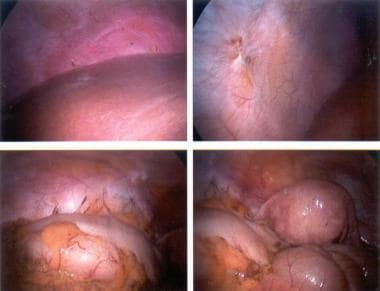 Adhesions due to endometriosis. 