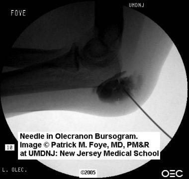Olecranon bursogram. This image shows a needle inj