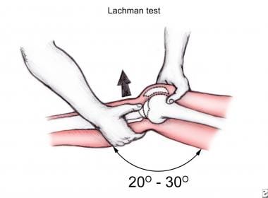 Lachman test. 
