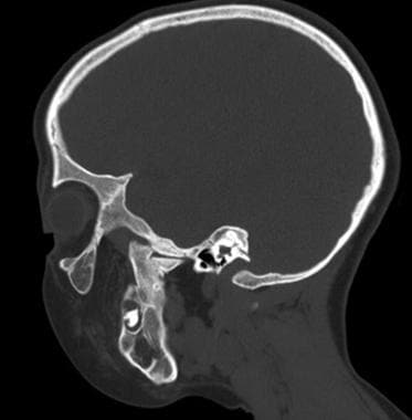 Temporomandibular joint ankylosis following distra
