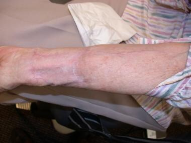 Donor site healed after reconstruction using AlloD
