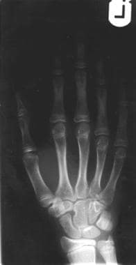 Plain radiograph of the left hand of a 10-year-old