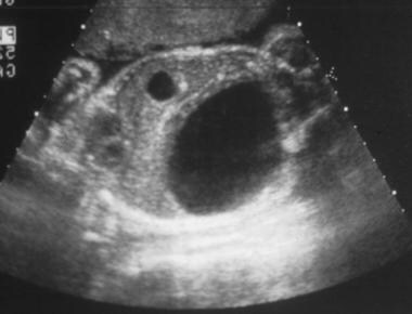 Genitourinary obstruction in a fetus with junction