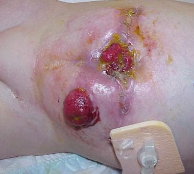 Skin irritation, stoma retraction, and wound infec
