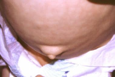 Which Findings Chest And Abdomen Are Characteristic Of Down Syndrome