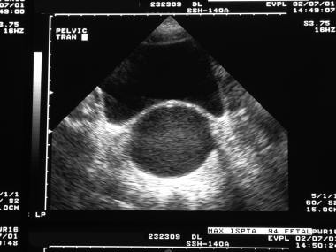 Transverse sonogram in an adolescent with imperfor