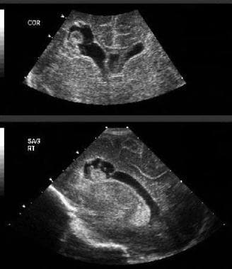 Periventricular hemorrhagic infarction (PVHI) with