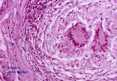 Granuloma within the intestinal mucosa secondary t