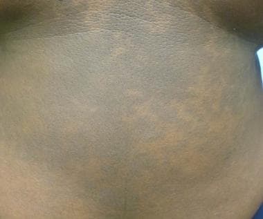 Treatment of Tinea Versicolor in the United States