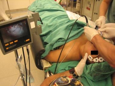 Intubation being performed with GlideScope. The en
