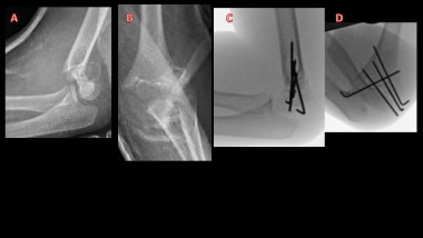 (A, B) Elbow radiographs of 7-year-old girl with t