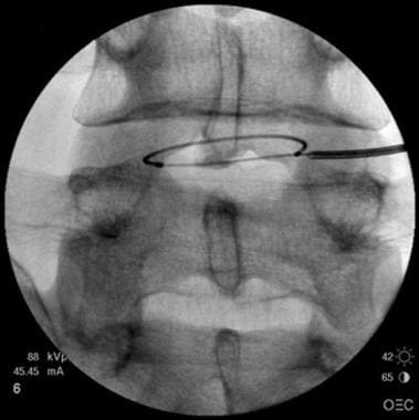 Anteroposterior fluoroscopy view shows catheter ar