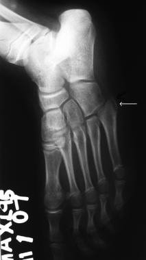 Osteochondrosis of the base of the fifth metatarsa