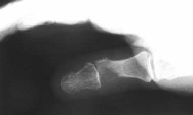 X-ray image demonstrating bony lucency at the dist