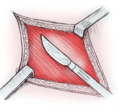 Appendectomy Diagram