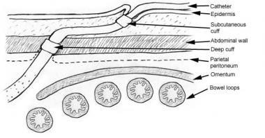 dialysis catheter types