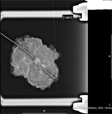 Excision biopsy of a breast lump