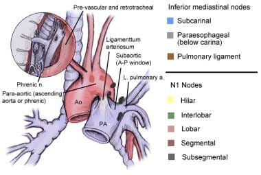 Mediastinal Lymphadenectomy: Background, Indications, Technical