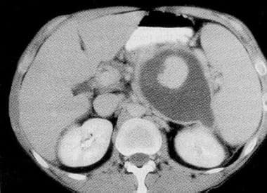 A CT scan with intravenous contrast enhancement (a