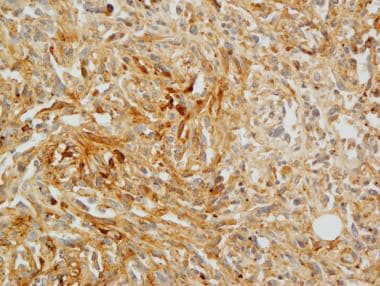 Pathology of nonmesothelial cancers of the pleura.