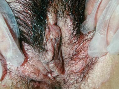 Benign vulvar lesions. Lichen sclerosus. 