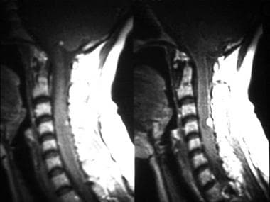 T1-weighted postgadolinium MRI shows 2 subpial, en