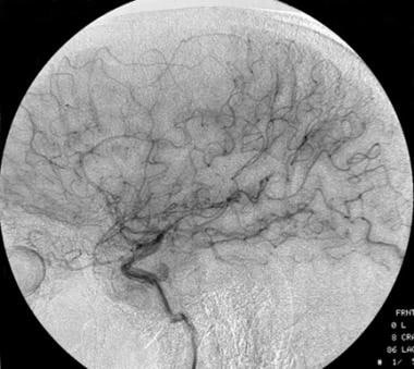 Lateral carotid angiograph of a low-grade oligoden