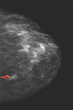 Skin of the affected breast subsequent to treatment. Following ~1