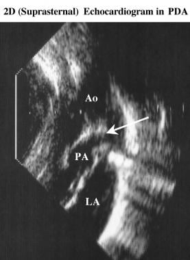 Two-dimensional echocardiogram (suprasternal view)