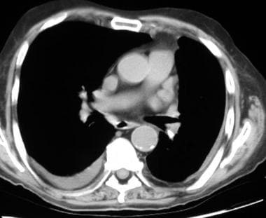 Aspiration pneumonia. CT scan through the lower-lo