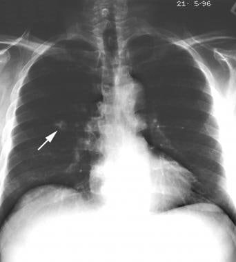 Posteroanterior (PA) chest radiograph in a man sho