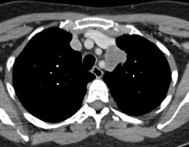 Lung Metastases Imaging: Overview, Radiography, Computed Tomography