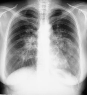 Sarcoidosis, thoracic. Posteroanterior chest radio