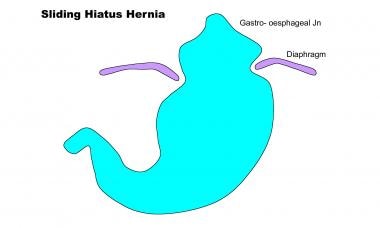 A diagram depicting a sliding hiatal hernia. The g