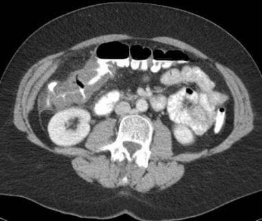 Mesenteric ischemia. CT scan in a 56-year-old woma