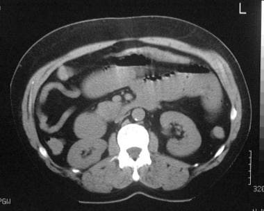 A nonenhanced CT scan at the level of the umbilicu