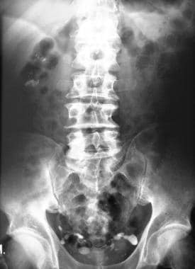 Plain abdominal radiograph in a male patient with 