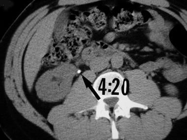 Axial nonenhanced CT section at the level of the k