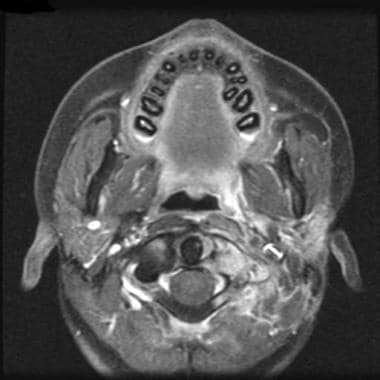 Parotid, malignant tumors. Axial T1-weighted MRI w