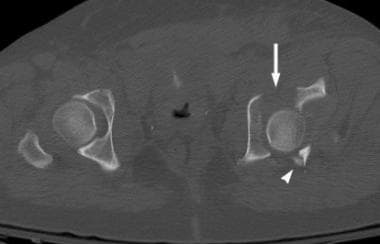 Computed tomography (CT) scan of a transverse frac