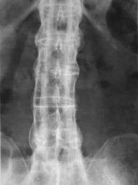 Bamboo spine. Frontal radiograph shows complete fu