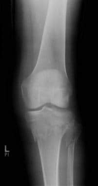 Tibial plateau fractures. Radiograph of the knee r