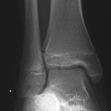 Mortise view in an 11-year-old girl with juvenile 