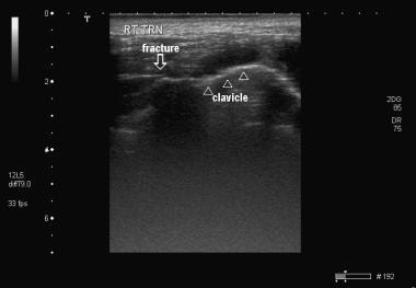 Ultrasonogram of a clavicular fracture 