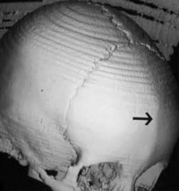 Trigonocephaly. Oblique view of the skull shows a 
