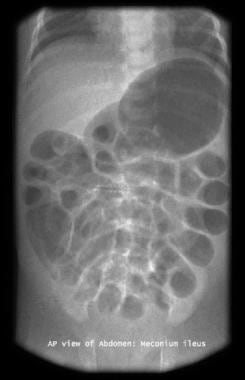 腹部x线片显示低位肠梗阻