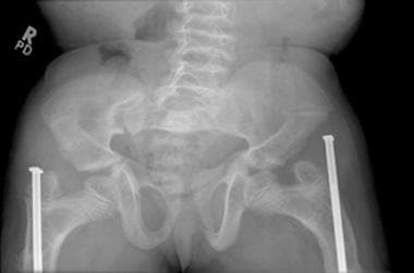 Frontal radiograph of the pelvis in a 9-year-old g